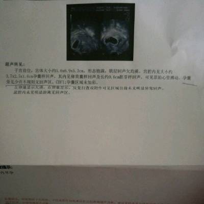用双胞胎做供卵助孕代怀试管风险大吗？