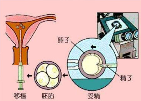 44岁还能做试管婴儿吗