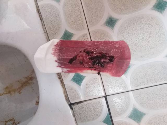 第二代试管婴儿的弊端